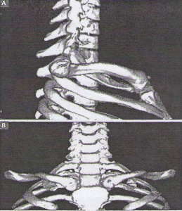 Os du thorax - Ostéologie